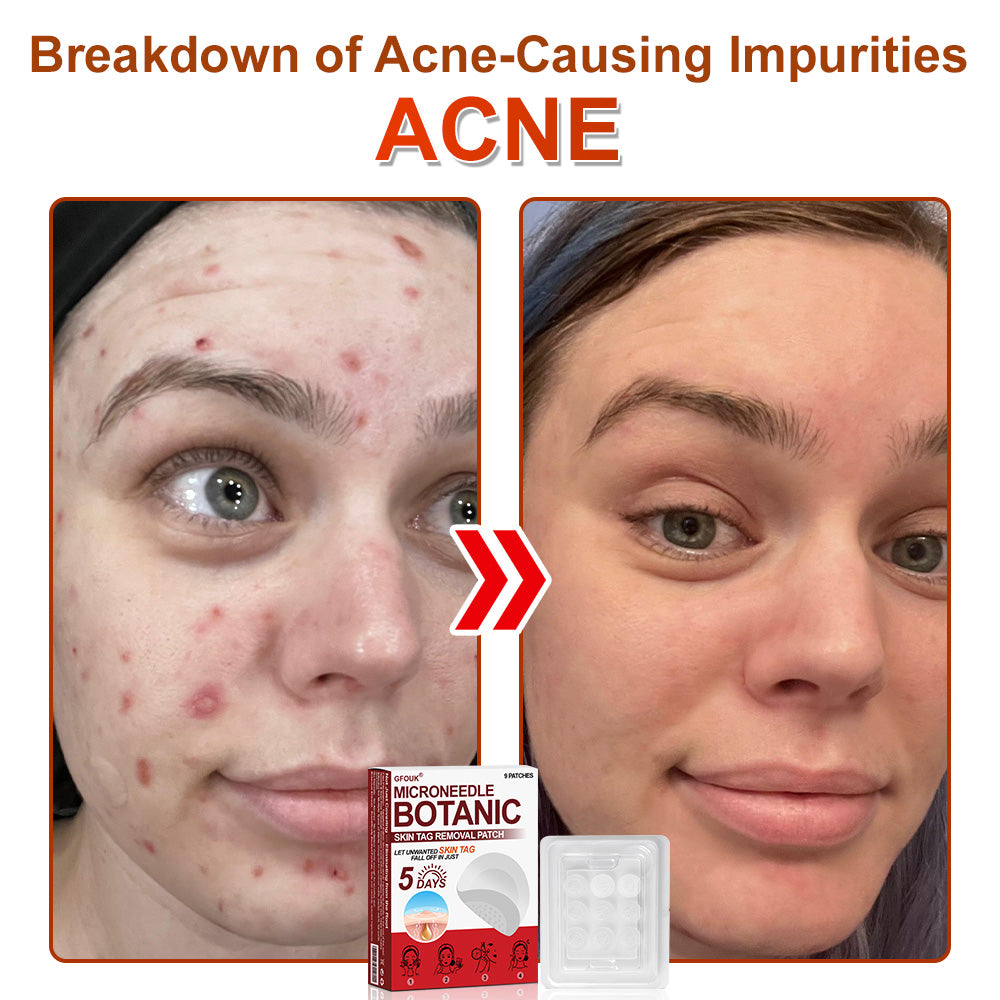 ✅𝐆𝐅𝐎𝐔𝐊® 𝐌𝐢𝐜𝐫𝐨𝐍𝐞𝐞𝐝𝐥𝐞 𝐁𝐨𝐭𝐚𝐧𝐢𝐜 𝐒𝐤𝐢𝐧 𝐓𝐚𝐠 𝐑𝐞𝐦𝐨𝐯𝐚𝐥 𝐏𝐚𝐭𝐜𝐡 –  𝐕𝐢𝐬𝐢𝐛𝐥𝐞 𝐑𝐞𝐬𝐮𝐥𝐭𝐬 𝐢𝐧 𝐉𝐮𝐬𝐭 𝟓 𝐃𝐚𝐲𝐬