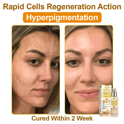 🐝𝐳𝐯𝐨𝐞𝐯𝐨® 𝐁𝐞𝐞 𝐕𝐞𝐧𝐨𝐦 𝐒𝐤𝐢𝐧 𝐒𝐩𝐫𝐚𝐲