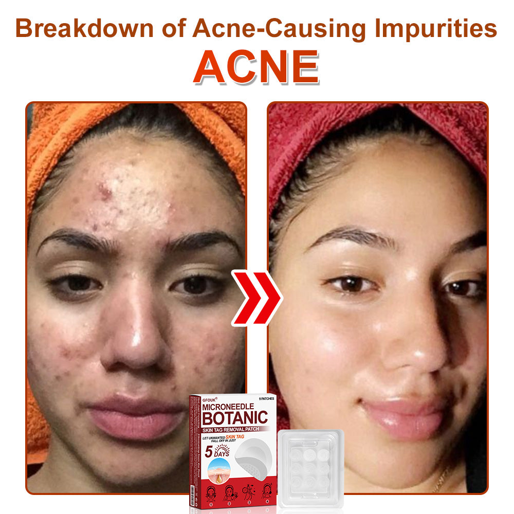 ✅𝐆𝐅𝐎𝐔𝐊® 𝐌𝐢𝐜𝐫𝐨𝐍𝐞𝐞𝐝𝐥𝐞 𝐁𝐨𝐭𝐚𝐧𝐢𝐜 𝐒𝐤𝐢𝐧 𝐓𝐚𝐠 𝐑𝐞𝐦𝐨𝐯𝐚𝐥 𝐏𝐚𝐭𝐜𝐡 –  𝐕𝐢𝐬𝐢𝐛𝐥𝐞 𝐑𝐞𝐬𝐮𝐥𝐭𝐬 𝐢𝐧 𝐉𝐮𝐬𝐭 𝟓 𝐃𝐚𝐲𝐬