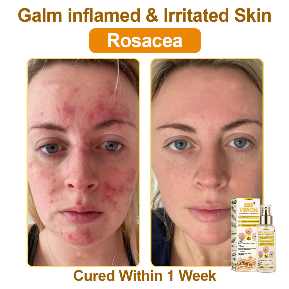 🐝𝐳𝐯𝐨𝐞𝐯𝐨® 𝐁𝐞𝐞 𝐕𝐞𝐧𝐨𝐦 𝐒𝐤𝐢𝐧 𝐒𝐩𝐫𝐚𝐲