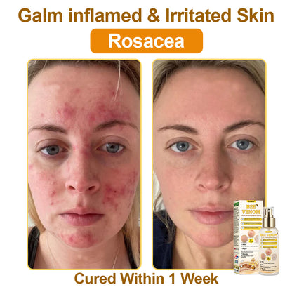 🐝𝐳𝐯𝐨𝐞𝐯𝐨® 𝐁𝐞𝐞 𝐕𝐞𝐧𝐨𝐦 𝐒𝐤𝐢𝐧 𝐒𝐩𝐫𝐚𝐲
