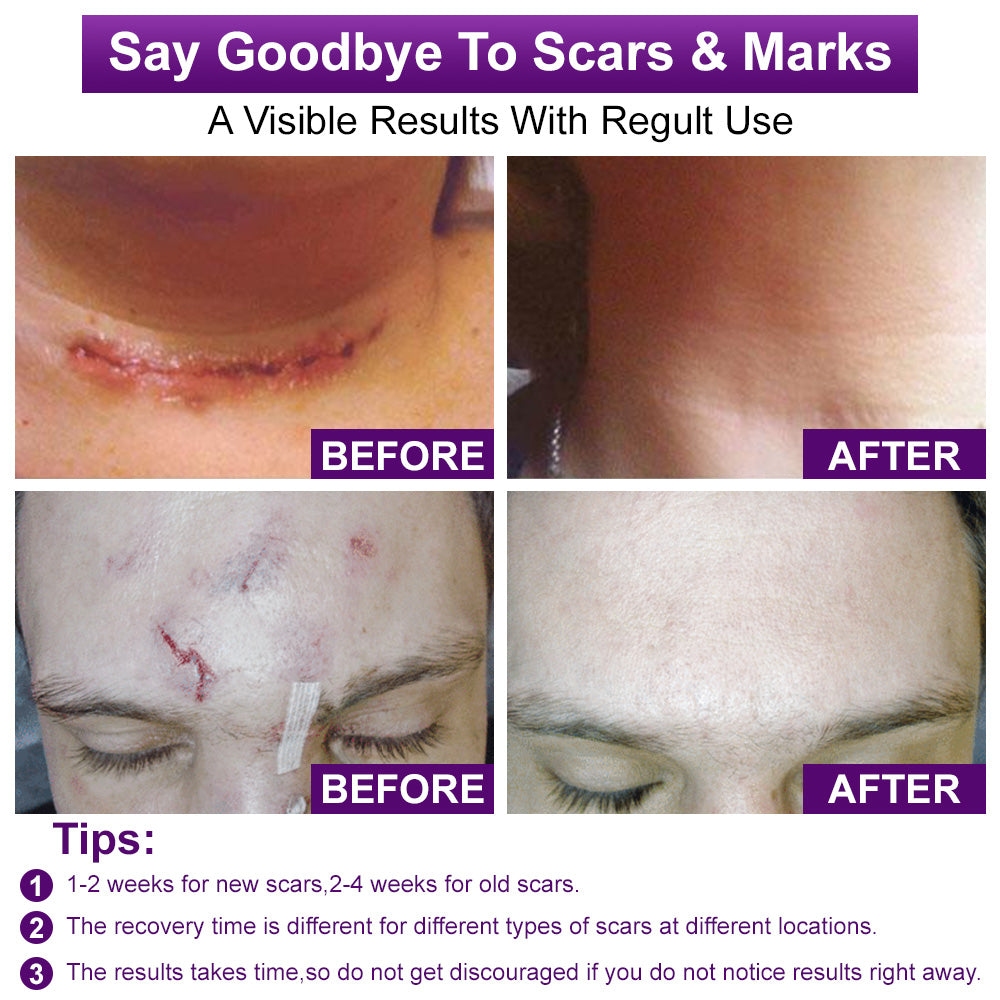 💙MHRA-CERTIFIED✅flysmus® cure FACE & BODY SCAR GEL – Clinically proven to soften, flatten and fade surgical scars, acne marks, burns, keloids and trauma-related scars.