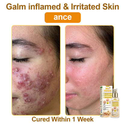 🐝𝐳𝐯𝐨𝐞𝐯𝐨® 𝐁𝐞𝐞 𝐕𝐞𝐧𝐨𝐦 𝐒𝐤𝐢𝐧 𝐒𝐩𝐫𝐚𝐲