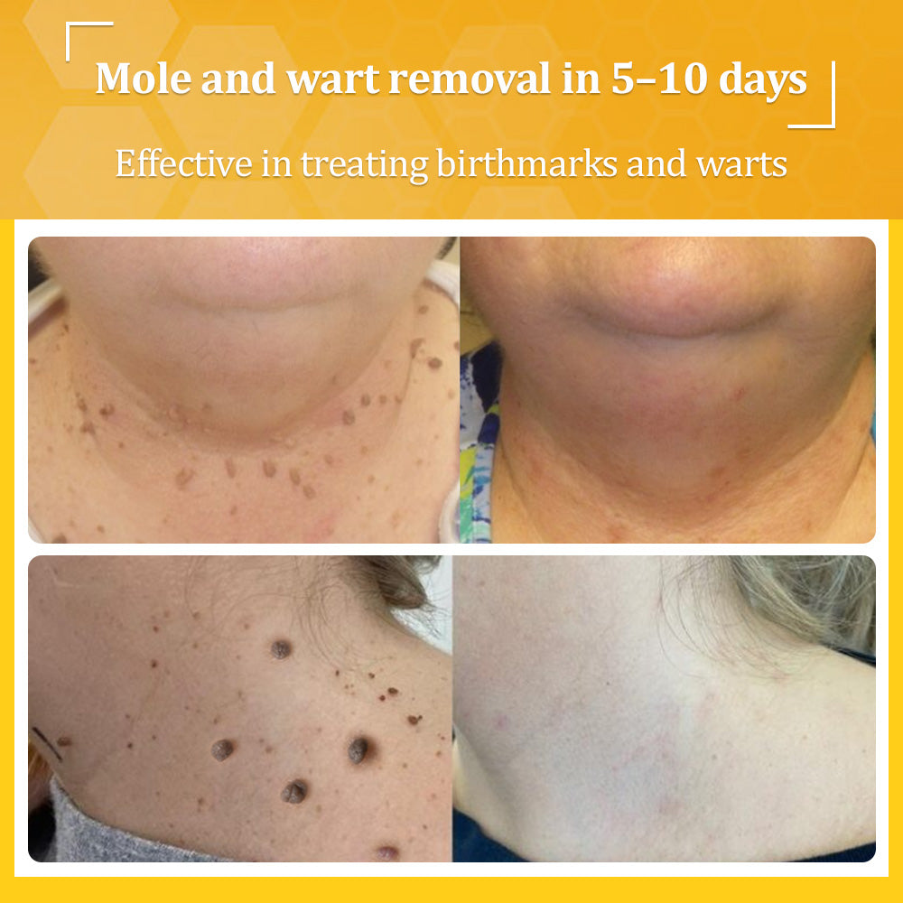 ✅𝐟𝐥𝐲𝐬𝐦𝐮𝐬® 𝐁𝐞𝐞 𝐕𝐞𝐧𝐨𝐦 𝐀𝐥𝐥-𝐢𝐧-𝐎𝐧𝐞 𝐂𝐫𝐞𝐚𝐦 – Provides effective relief for stubborn warts, skin bumps, lesions, infections, and scars.