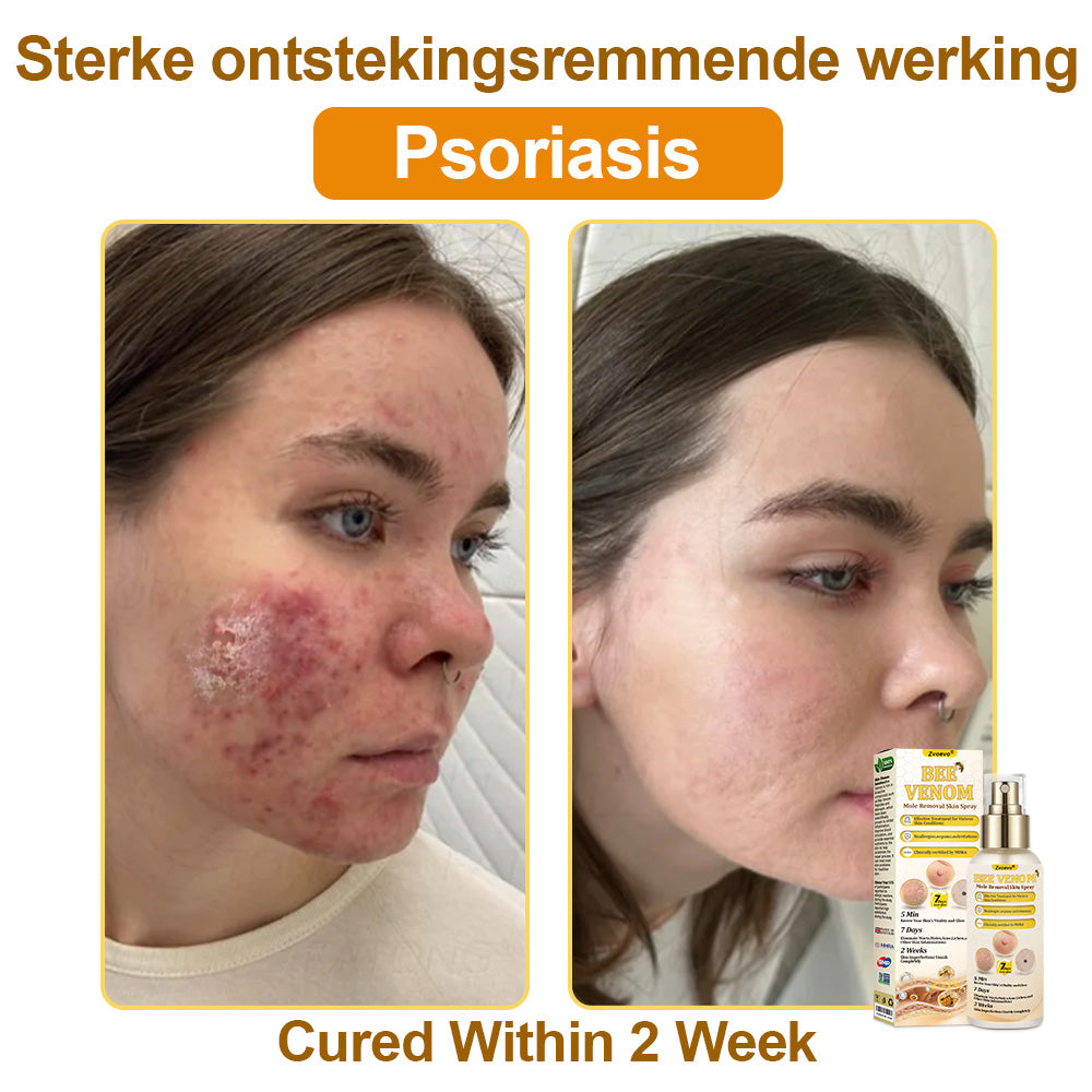 🐝𝐳𝐯𝐨𝐞𝐯𝐨® 𝐁𝐞𝐞 𝐕𝐞𝐧𝐨𝐦 𝐒𝐤𝐢𝐧 𝐒𝐩𝐫𝐚𝐲
