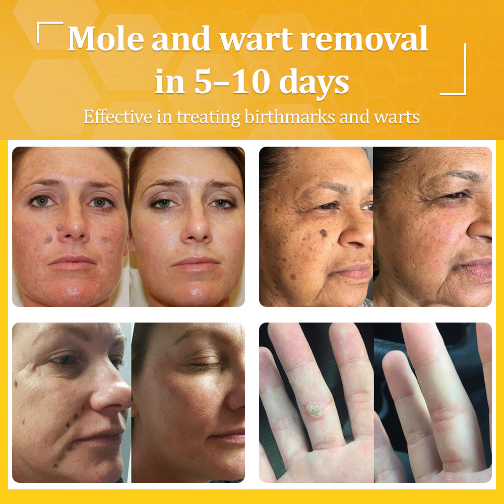 ✅𝐟𝐥𝐲𝐬𝐦𝐮𝐬® 𝐁𝐞𝐞 𝐕𝐞𝐧𝐨𝐦 𝐀𝐥𝐥-𝐢𝐧-𝐎𝐧𝐞 𝐂𝐫𝐞𝐚𝐦 – Provides effective relief for stubborn warts, skin bumps, lesions, infections, and scars.