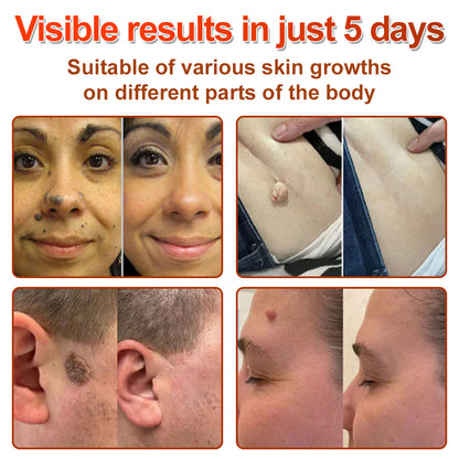 ✅𝐆𝐅𝐎𝐔𝐊® 𝐌𝐢𝐜𝐫𝐨𝐍𝐞𝐞𝐝𝐥𝐞 𝐁𝐨𝐭𝐚𝐧𝐢𝐜 𝐒𝐤𝐢𝐧 𝐓𝐚𝐠 𝐑𝐞𝐦𝐨𝐯𝐚𝐥 𝐏𝐚𝐭𝐜𝐡 –  𝐕𝐢𝐬𝐢𝐛𝐥𝐞 𝐑𝐞𝐬𝐮𝐥𝐭𝐬 𝐢𝐧 𝐉𝐮𝐬𝐭 𝟓 𝐃𝐚𝐲𝐬