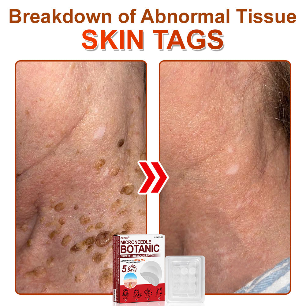 ✅𝐆𝐅𝐎𝐔𝐊® 𝐌𝐢𝐜𝐫𝐨𝐍𝐞𝐞𝐝𝐥𝐞 𝐁𝐨𝐭𝐚𝐧𝐢𝐜 𝐒𝐤𝐢𝐧 𝐓𝐚𝐠 𝐑𝐞𝐦𝐨𝐯𝐚𝐥 𝐏𝐚𝐭𝐜𝐡 –  𝐕𝐢𝐬𝐢𝐛𝐥𝐞 𝐑𝐞𝐬𝐮𝐥𝐭𝐬 𝐢𝐧 𝐉𝐮𝐬𝐭 𝟓 𝐃𝐚𝐲𝐬