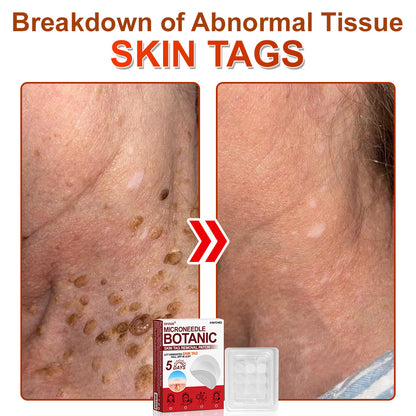 ✅𝐆𝐅𝐎𝐔𝐊® 𝐌𝐢𝐜𝐫𝐨𝐍𝐞𝐞𝐝𝐥𝐞 𝐁𝐨𝐭𝐚𝐧𝐢𝐜 𝐒𝐤𝐢𝐧 𝐓𝐚𝐠 𝐑𝐞𝐦𝐨𝐯𝐚𝐥 𝐏𝐚𝐭𝐜𝐡 –  𝐕𝐢𝐬𝐢𝐛𝐥𝐞 𝐑𝐞𝐬𝐮𝐥𝐭𝐬 𝐢𝐧 𝐉𝐮𝐬𝐭 𝟓 𝐃𝐚𝐲𝐬