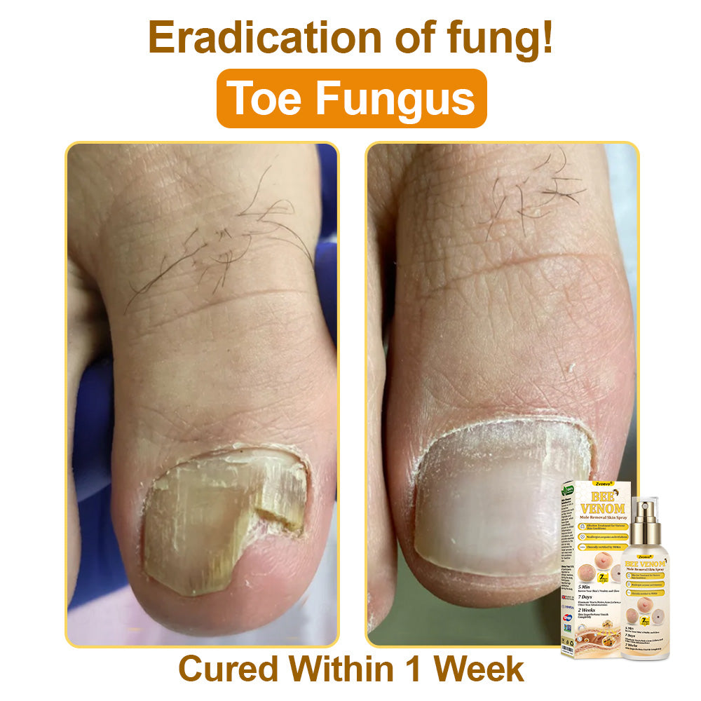 🐝𝐳𝐯𝐨𝐞𝐯𝐨® 𝐁𝐞𝐞 𝐕𝐞𝐧𝐨𝐦 𝐒𝐤𝐢𝐧 𝐒𝐩𝐫𝐚𝐲