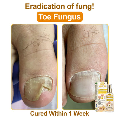 🐝𝐳𝐯𝐨𝐞𝐯𝐨® 𝐁𝐞𝐞 𝐕𝐞𝐧𝐨𝐦 𝐒𝐤𝐢𝐧 𝐒𝐩𝐫𝐚𝐲