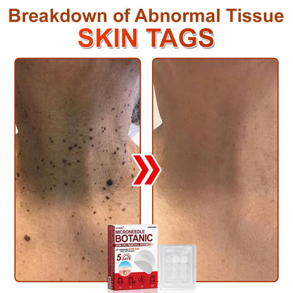 ✅𝐆𝐅𝐎𝐔𝐊® 𝐌𝐢𝐜𝐫𝐨𝐍𝐞𝐞𝐝𝐥𝐞 𝐁𝐨𝐭𝐚𝐧𝐢𝐜 𝐒𝐤𝐢𝐧 𝐓𝐚𝐠 𝐑𝐞𝐦𝐨𝐯𝐚𝐥 𝐏𝐚𝐭𝐜𝐡 –  𝐕𝐢𝐬𝐢𝐛𝐥𝐞 𝐑𝐞𝐬𝐮𝐥𝐭𝐬 𝐢𝐧 𝐉𝐮𝐬𝐭 𝟓 𝐃𝐚𝐲𝐬