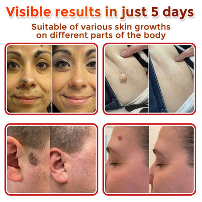 ❣️𝐆𝐅𝐎𝐔𝐊® 𝐌𝐢𝐜𝐫𝐨𝐍𝐞𝐞𝐝𝐥𝐞 𝐁𝐨𝐭𝐚𝐧𝐢𝐜 𝐒𝐤𝐢𝐧 𝐓𝐚𝐠 𝐑𝐞𝐦𝐨𝐯𝐚𝐥 𝐏𝐚𝐭𝐜𝐡 – 𝐕𝐢𝐬𝐢𝐛𝐥𝐞 𝐑𝐞𝐬𝐮𝐥𝐭𝐬 𝐢𝐧 𝐉𝐮𝐬𝐭 𝟓 𝐃𝐚𝐲𝐬