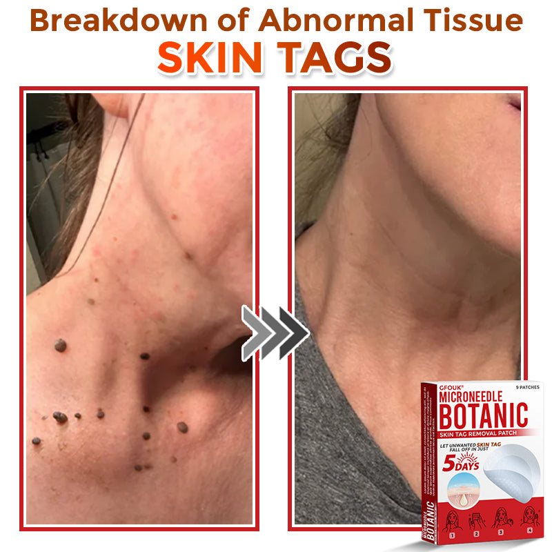 🔥𝐆𝐅𝐎𝐔𝐊® 𝐌𝐢𝐜𝐫𝐨𝐍𝐞𝐞𝐝𝐥𝐞 𝐁𝐨𝐭𝐚𝐧𝐢𝐜 𝐒𝐤𝐢𝐧 𝐓𝐚𝐠 𝐑𝐞𝐦𝐨𝐯𝐚𝐥 𝐏𝐚𝐭𝐜𝐡 – 𝐕𝐢𝐬𝐢𝐛𝐥𝐞 𝐑𝐞𝐬𝐮𝐥𝐭𝐬 𝐢𝐧 𝐉𝐮𝐬𝐭 𝟓 𝐃𝐚𝐲𝐬