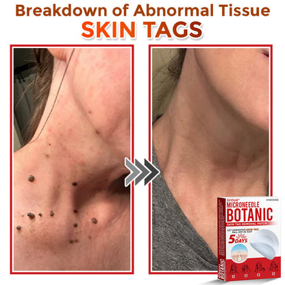 🔥𝐆𝐅𝐎𝐔𝐊® 𝐌𝐢𝐜𝐫𝐨𝐍𝐞𝐞𝐝𝐥𝐞 𝐁𝐨𝐭𝐚𝐧𝐢𝐜 𝐒𝐤𝐢𝐧 𝐓𝐚𝐠 𝐑𝐞𝐦𝐨𝐯𝐚𝐥 𝐏𝐚𝐭𝐜𝐡 – 𝐕𝐢𝐬𝐢𝐛𝐥𝐞 𝐑𝐞𝐬𝐮𝐥𝐭𝐬 𝐢𝐧 𝐉𝐮𝐬𝐭 𝟓 𝐃𝐚𝐲𝐬