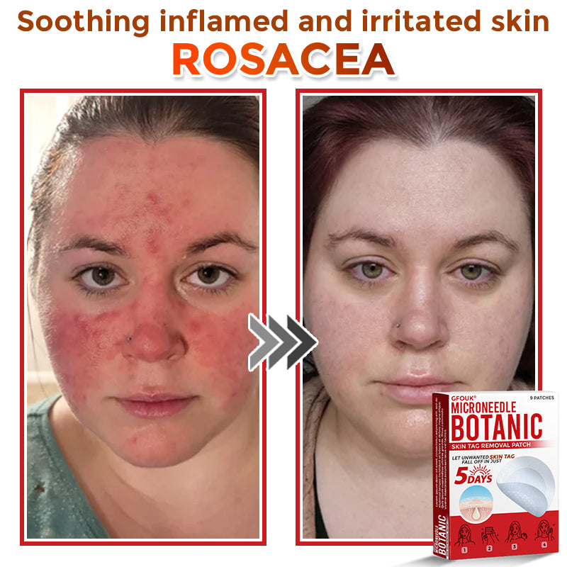 ❣️𝐆𝐅𝐎𝐔𝐊® 𝐌𝐢𝐜𝐫𝐨𝐍𝐞𝐞𝐝𝐥𝐞 𝐁𝐨𝐭𝐚𝐧𝐢𝐜 𝐒𝐤𝐢𝐧 𝐓𝐚𝐠 𝐑𝐞𝐦𝐨𝐯𝐚𝐥 𝐏𝐚𝐭𝐜𝐡 – 𝐕𝐢𝐬𝐢𝐛𝐥𝐞 𝐑𝐞𝐬𝐮𝐥𝐭𝐬 𝐢𝐧 𝐉𝐮𝐬𝐭 𝟓 𝐃𝐚𝐲𝐬