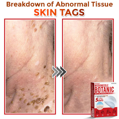 🔥𝐆𝐅𝐎𝐔𝐊® 𝐌𝐢𝐜𝐫𝐨𝐍𝐞𝐞𝐝𝐥𝐞 𝐁𝐨𝐭𝐚𝐧𝐢𝐜 𝐒𝐤𝐢𝐧 𝐓𝐚𝐠 𝐑𝐞𝐦𝐨𝐯𝐚𝐥 𝐏𝐚𝐭𝐜𝐡 – 𝐕𝐢𝐬𝐢𝐛𝐥𝐞 𝐑𝐞𝐬𝐮𝐥𝐭𝐬 𝐢𝐧 𝐉𝐮𝐬𝐭 𝟓 𝐃𝐚𝐲𝐬