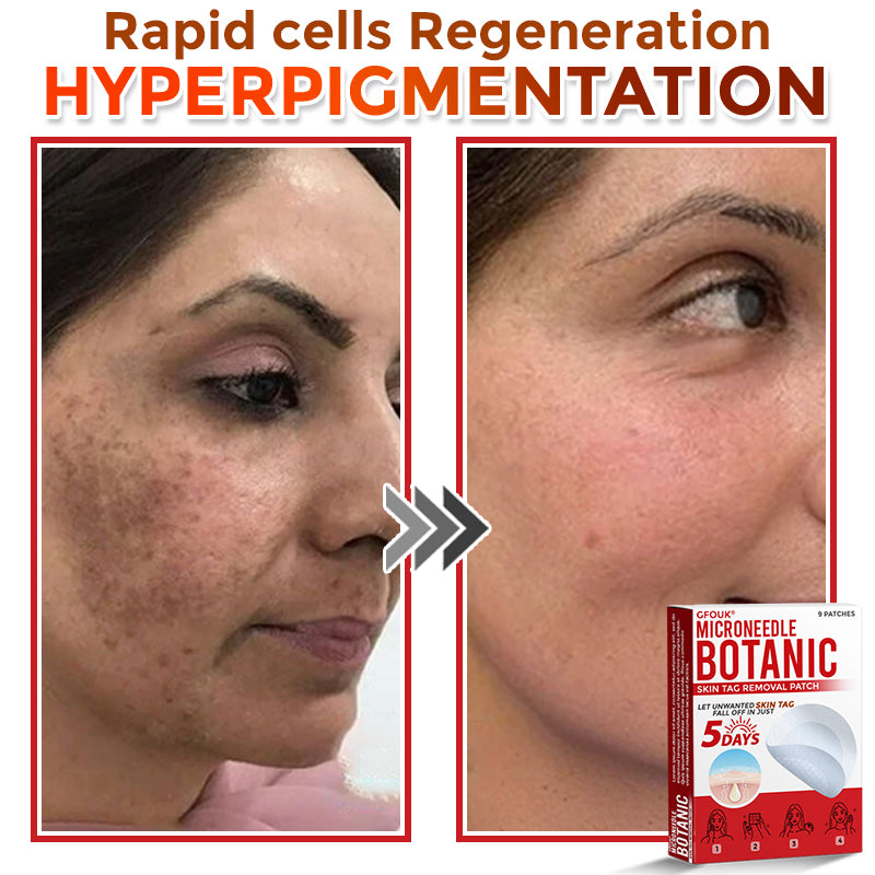 ❣️𝐆𝐅𝐎𝐔𝐊® 𝐌𝐢𝐜𝐫𝐨𝐍𝐞𝐞𝐝𝐥𝐞 𝐁𝐨𝐭𝐚𝐧𝐢𝐜 𝐒𝐤𝐢𝐧 𝐓𝐚𝐠 𝐑𝐞𝐦𝐨𝐯𝐚𝐥 𝐏𝐚𝐭𝐜𝐡 – 𝐕𝐢𝐬𝐢𝐛𝐥𝐞 𝐑𝐞𝐬𝐮𝐥𝐭𝐬 𝐢𝐧 𝐉𝐮𝐬𝐭 𝟓 𝐃𝐚𝐲𝐬