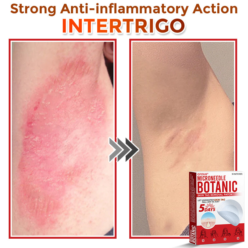 ❣️𝐆𝐅𝐎𝐔𝐊® 𝐌𝐢𝐜𝐫𝐨𝐍𝐞𝐞𝐝𝐥𝐞 𝐁𝐨𝐭𝐚𝐧𝐢𝐜 𝐒𝐤𝐢𝐧 𝐓𝐚𝐠 𝐑𝐞𝐦𝐨𝐯𝐚𝐥 𝐏𝐚𝐭𝐜𝐡 – 𝐕𝐢𝐬𝐢𝐛𝐥𝐞 𝐑𝐞𝐬𝐮𝐥𝐭𝐬 𝐢𝐧 𝐉𝐮𝐬𝐭 𝟓 𝐃𝐚𝐲𝐬