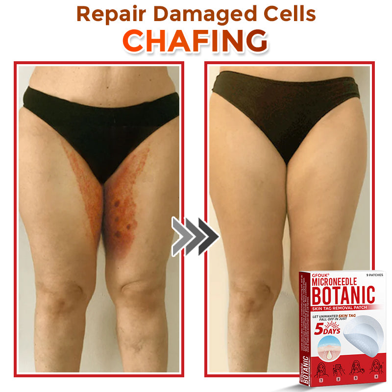 🔥𝐆𝐅𝐎𝐔𝐊® 𝐌𝐢𝐜𝐫𝐨𝐍𝐞𝐞𝐝𝐥𝐞 𝐁𝐨𝐭𝐚𝐧𝐢𝐜 𝐒𝐤𝐢𝐧 𝐓𝐚𝐠 𝐑𝐞𝐦𝐨𝐯𝐚𝐥 𝐏𝐚𝐭𝐜𝐡 – 𝐕𝐢𝐬𝐢𝐛𝐥𝐞 𝐑𝐞𝐬𝐮𝐥𝐭𝐬 𝐢𝐧 𝐉𝐮𝐬𝐭 𝟓 𝐃𝐚𝐲𝐬