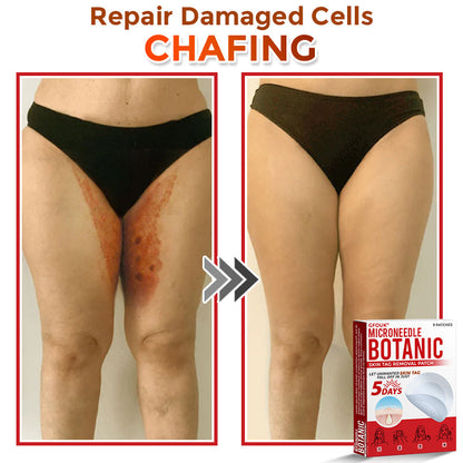 ❣️𝐆𝐅𝐎𝐔𝐊® 𝐌𝐢𝐜𝐫𝐨𝐍𝐞𝐞𝐝𝐥𝐞 𝐁𝐨𝐭𝐚𝐧𝐢𝐜 𝐒𝐤𝐢𝐧 𝐓𝐚𝐠 𝐑𝐞𝐦𝐨𝐯𝐚𝐥 𝐏𝐚𝐭𝐜𝐡 – 𝐕𝐢𝐬𝐢𝐛𝐥𝐞 𝐑𝐞𝐬𝐮𝐥𝐭𝐬 𝐢𝐧 𝐉𝐮𝐬𝐭 𝟓 𝐃𝐚𝐲𝐬