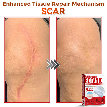 ❣️𝐆𝐅𝐎𝐔𝐊® 𝐌𝐢𝐜𝐫𝐨𝐍𝐞𝐞𝐝𝐥𝐞 𝐁𝐨𝐭𝐚𝐧𝐢𝐜 𝐒𝐤𝐢𝐧 𝐓𝐚𝐠 𝐑𝐞𝐦𝐨𝐯𝐚𝐥 𝐏𝐚𝐭𝐜𝐡 – 𝐕𝐢𝐬𝐢𝐛𝐥𝐞 𝐑𝐞𝐬𝐮𝐥𝐭𝐬 𝐢𝐧 𝐉𝐮𝐬𝐭 𝟓 𝐃𝐚𝐲𝐬